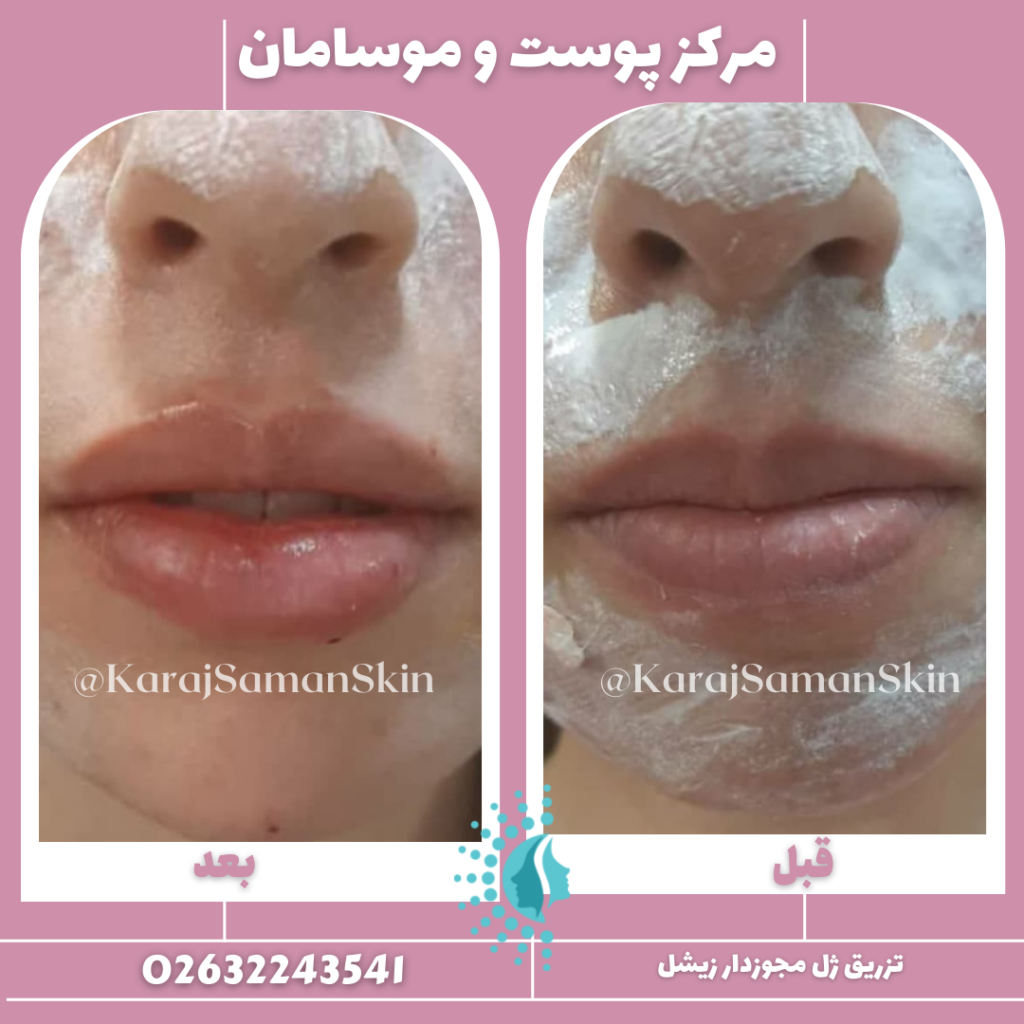 تزریق ژل لب در کرج